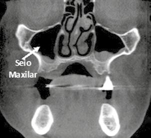 0013), também denominado de cavidade antral. 15۰ Sequência de cortes transaxiais (cortes 63 ao 68 com 1mm de espessura e 1 mm de espaçamento) evidenciando o canal incisivo.