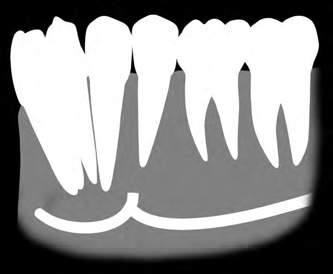 extensão do canal mandibular anterior à saída do forame mentual.