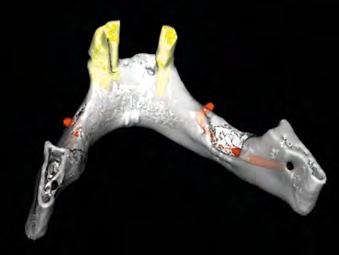 Corte coronal panorâmico evidenciando a transmigração do pré-molar, já alcançando a linha média da