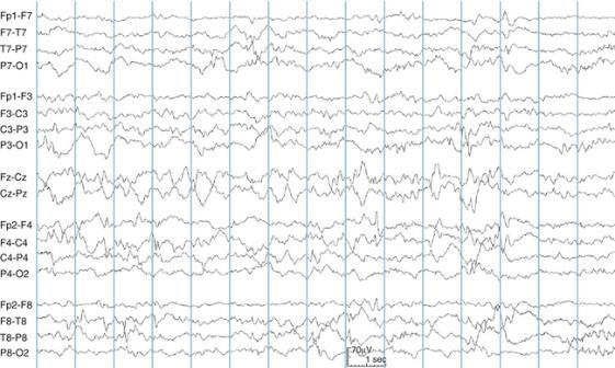 Sono calmo Padrões EEG - ondas de alta voltagem lentas (HSV), tracé alternant