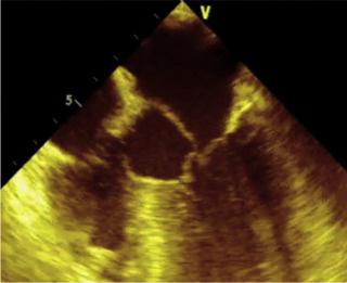 Figura 17 Movimento sistólico anterior da valva mitral. Figura 18 Complexo aórtico. VE, ventrículo esquerdo; VSVE; via de saída do ventrículo esquerdo; VSVD, via de saída do ventrículo direito.