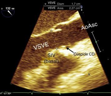 Figura 20 Corte esôfago médio valva aórtica eixo longo. VSVE: via de saída do ventrículo esquerdo; SIV: septo interventricular; CD: Coronariana direita; Ao Asc: Aorta ascendente.