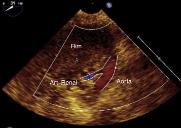 Figura 21 Corte da artéria renal. Figura 22 Placas de ateroma na aorta descendente eixo curto.