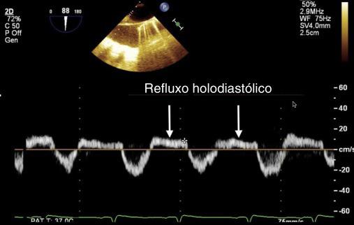 Figura 23 Doppler pulsátil na aorta descendente demonstra um refluxo holodiastólico de regurgitação aórtica grave. Figura 24 Análise tridimensional volumétrica da valva aórtica.