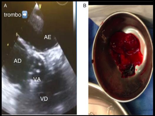 Figura 28 (A) Imagem ecocardiográfica de trombo em átrio esquerdo. (B) Trombo. AE: Átrio esquerdo; AD: Átrio direito; VA: Valva aórtica; VD: Ventrículo direito.