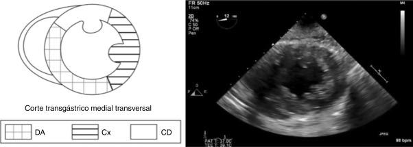 Figura 31 Relação anatômica e irrigação coronariana com as paredes do ventrículo esquerdo no corte transgástrico eixo curto mediopapilar.