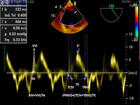 Figura 33 Imagem de Doppler tecidual no anel tricuspídeo: S : velocidade de pico longitudinal do ventrículo direito; IPMVD: índice de desempenho miocárdico do ventrículo direito ou índice de Tei;