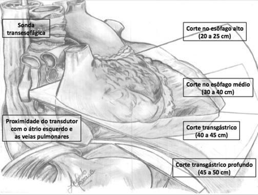 Figura 1 Relações anatômicas entre a sonda transesofágica, o esôfago e o coração. 0.