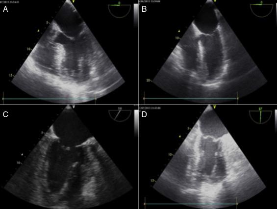 Manipulação da sonda do ecocardiograma transesofágico O correto uso das funções da sonda de ETE multiplanar proporciona obtenção adequada das imagens cardíacas durante o exame intraoperatório.