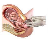sobre o colo do útero, o que gera retroacção