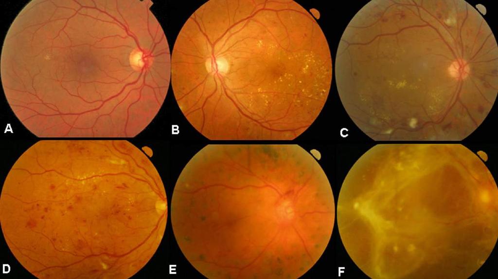 Retinopatia Diabética / Biomarcador "O Fundo de Olho define a dinâmica da avaliação customizando o atendimento" Ferramenta de