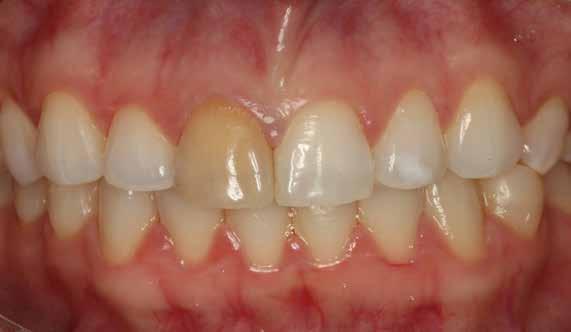 Carvalho BM 290 INTRODUÇÃO A estética dos dentes anteriores é uma das principais solicitações dos pacientes, que procuram os consultórios odontológicos.
