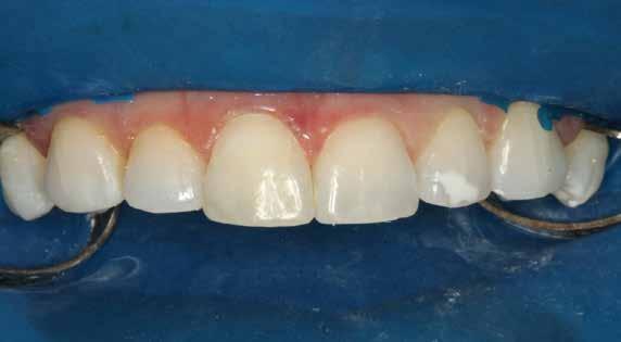 Essa pasta permaneceu no dente por 8 dias com a finalidade de neutralizar o ph do meio e permitir total liberação do oxigênio, que causa a diminuição da resistência de união da resina à estrutura