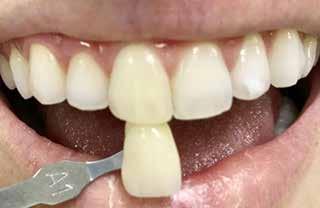 Para complementar os efeitos do clareamento realizado no consultório, foi aplicado Peróxido de Carbamida 16 % (Whiteness Perfect FGM Joinville, SC) com moldeira, apenas no dente 11, pela técnica