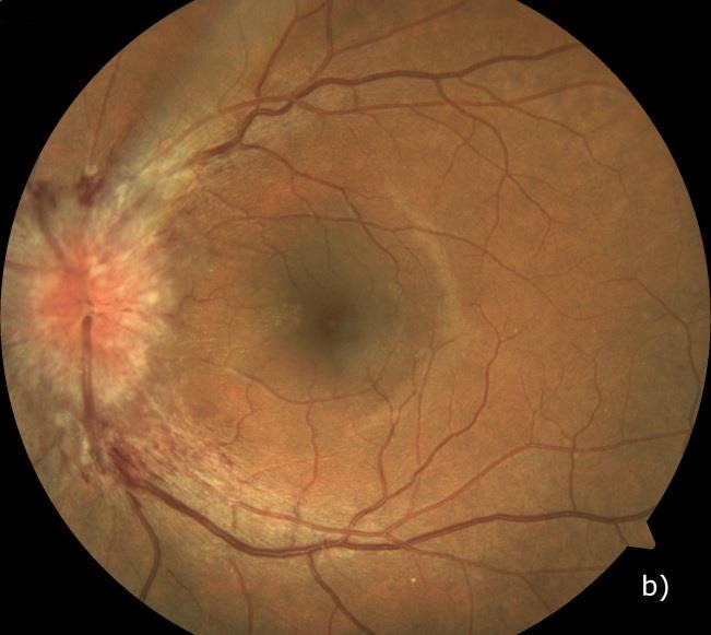 2.2 Avaliação da Saúde Ocular Avaliação Pupilar: Pupilas Isocóricas Redondas e Reativas à Luz e à Acomodação (PIRRLA); MEO: normal; Biomicroscopia: ausência de opacidades ou anomalias nas