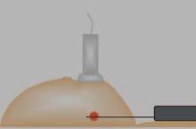 CORE BIOPSY POSIÇÃO DA AGULHA vs.