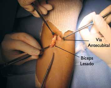 LESÃO DO BÍCEPS DISTAL: AVALIAÇÃO FUNCIONAL E DINAMOMETRIA DIGITAL DA SUA RECONSTRUÇÃO PELA TÉCNICA DA MINIDUPLA VIA DE MAYO 583 Figura 1 - Via antecubital. Figura 2 - Via lateral.