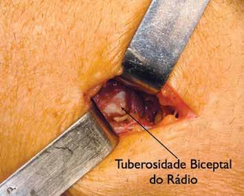 A cirurgia realizada rebaixou o bíceps com uso de enxerto de semitendíneo até a inserção do músculo braquial, pois mesmo com enxerto não foi possível alcançar a tuberosidade radial.