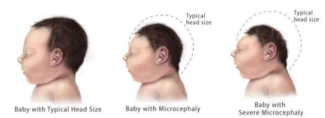 MICROCEFALIA ARTROGRIPOSE Síndrome de Guillain-Barré (formigamento, fraqueza muscular e até paralisia) Leucopenia (diminuição dos