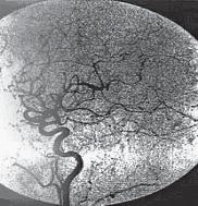 56 A B C D E F FIGURA 1 Em A, B e C angiografia cerebral digital com MAV de lobo parietal direito.