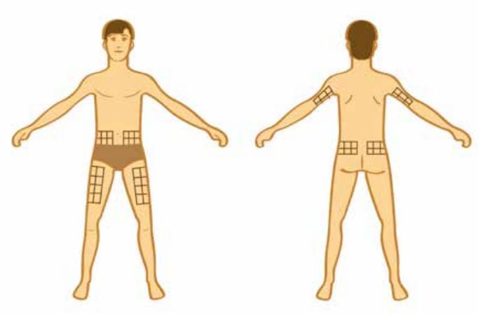 Locais de aplicação das Insulinas rodízio nos locais de aplicação é importante na prevenção de lipo-hipertrofia