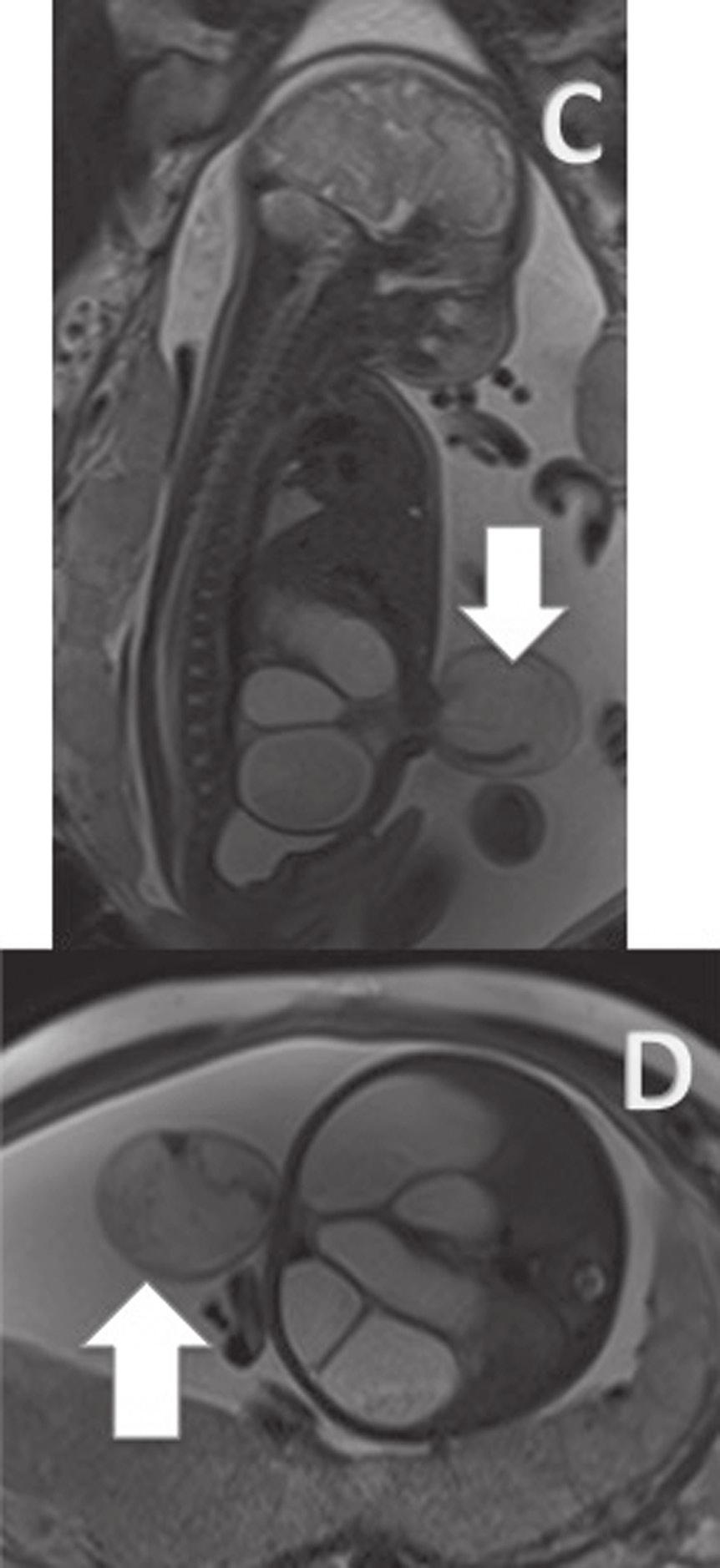 O estudo por RM mostra alças intestinais herniadas pela parede intestinal flutuando livremente no líquido amniótico.