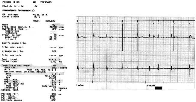 mitiu o controle da paciente. A energia ventricular foi programada em 2,3 Volts, com limiar de comando de 1,8 Volts. Verificada a medida, o eletrodo mostrou-se estável.