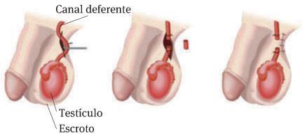 Ocorre um corte nas trompas de Falópio que impedem a deslocação dos óvulos e dos espermatozóides.