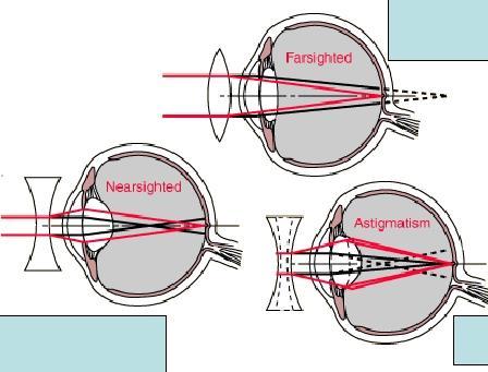 Problemas de visão Hipermetropia: Olho curto enxerga mal de perto Miopia olho comprido :