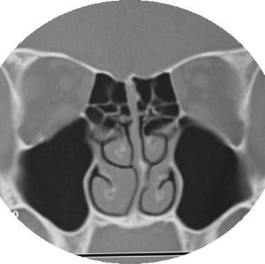 CORONAL