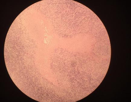 orientação terapêutica. O rx de tórax é normal e exclui-se tuberculose pulmonar. A cultura para microorganismo é negativa.