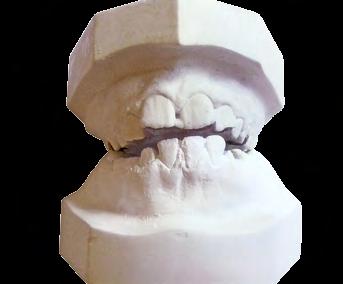 desoclusão dos segmentos dentários posteriores.