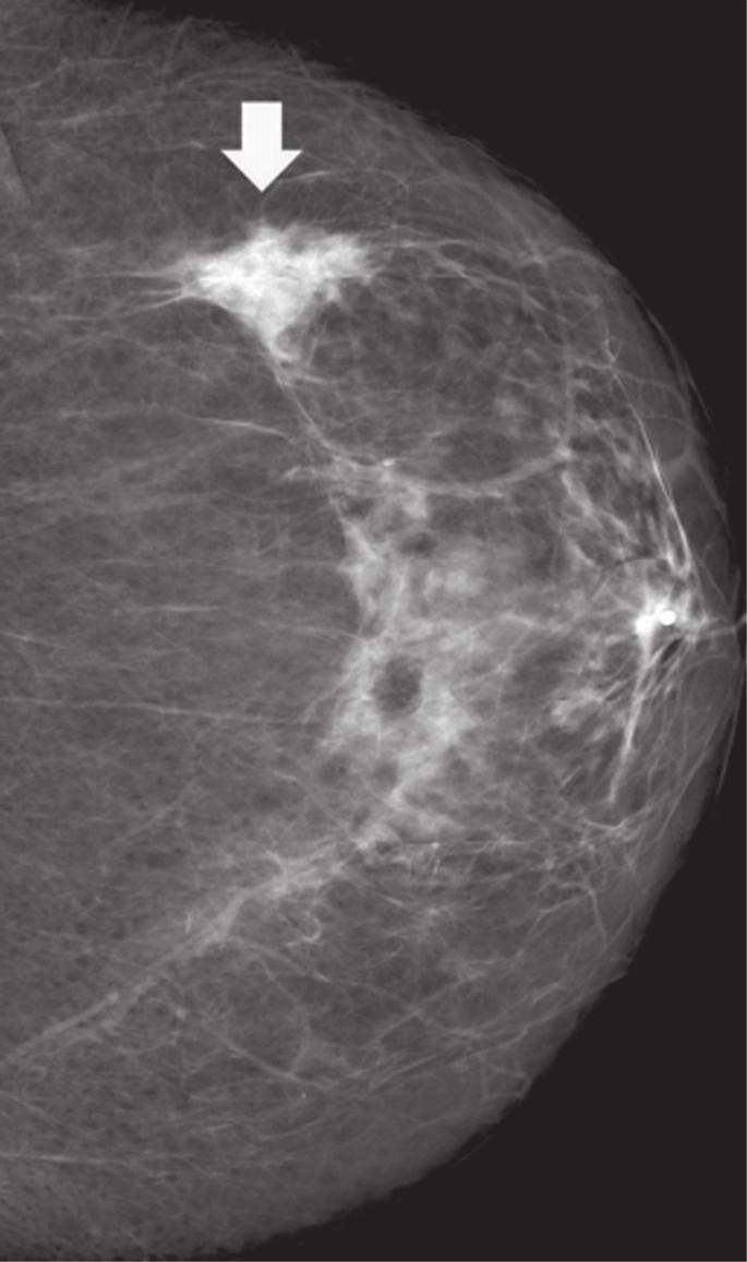 Na mamografia, nota-se assimetria focal ou nódulo sólido, geralmente na região retroareolar, sem calcificações associadas (Figura 1), cujo aspecto ultrassonográfico é de nódulo hipoecogênico com