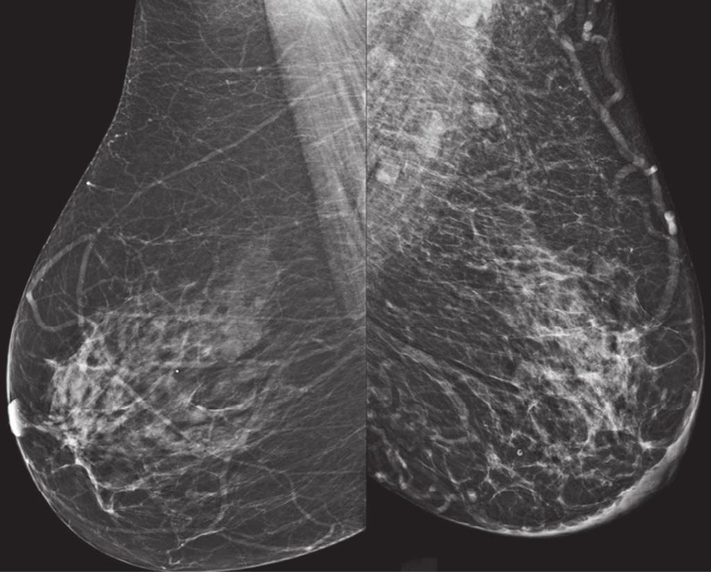 Matsumoto REK et al. / spectos de imagem da mama em doenças sistêmicas LMLO LMLO Figura 4.