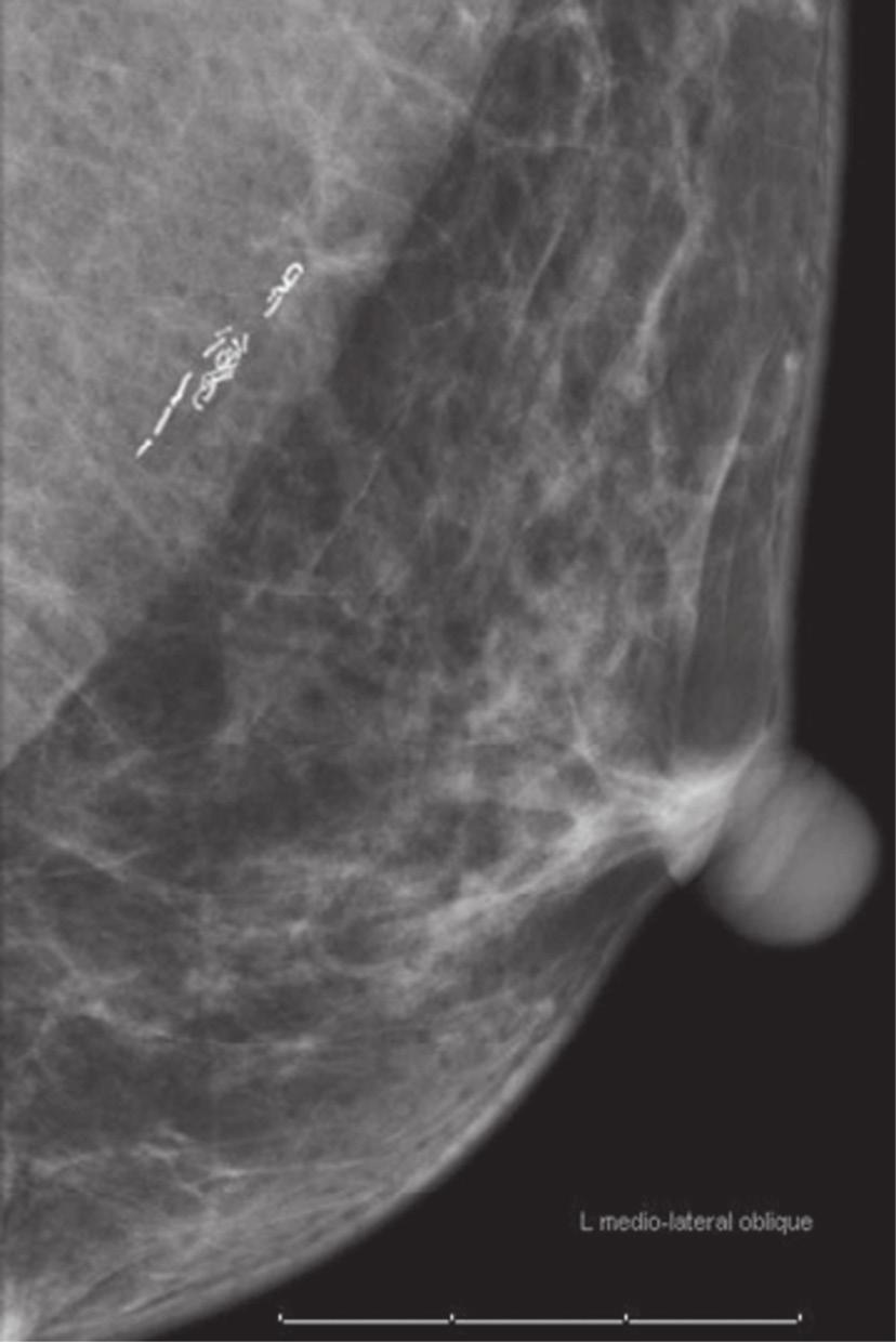 Matsumoto REK et al. / spectos de imagem da mama em doenças sistêmicas Figura 7.
