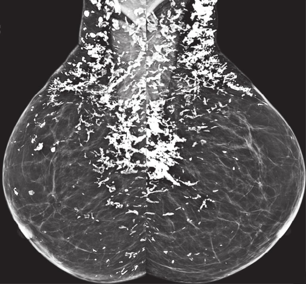 Matsumoto REK et al. / spectos de imagem da mama em doenças sistêmicas Figura 11.