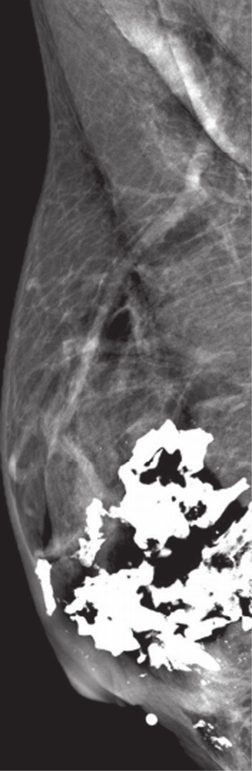 Paciente do sexo feminino, de 41 anos, com calcificações grosseiras e distróficas na região retroareolar da mama direita. Em acompanhamento reumatológico por lúpus eritematoso sistêmico. Figura 12.