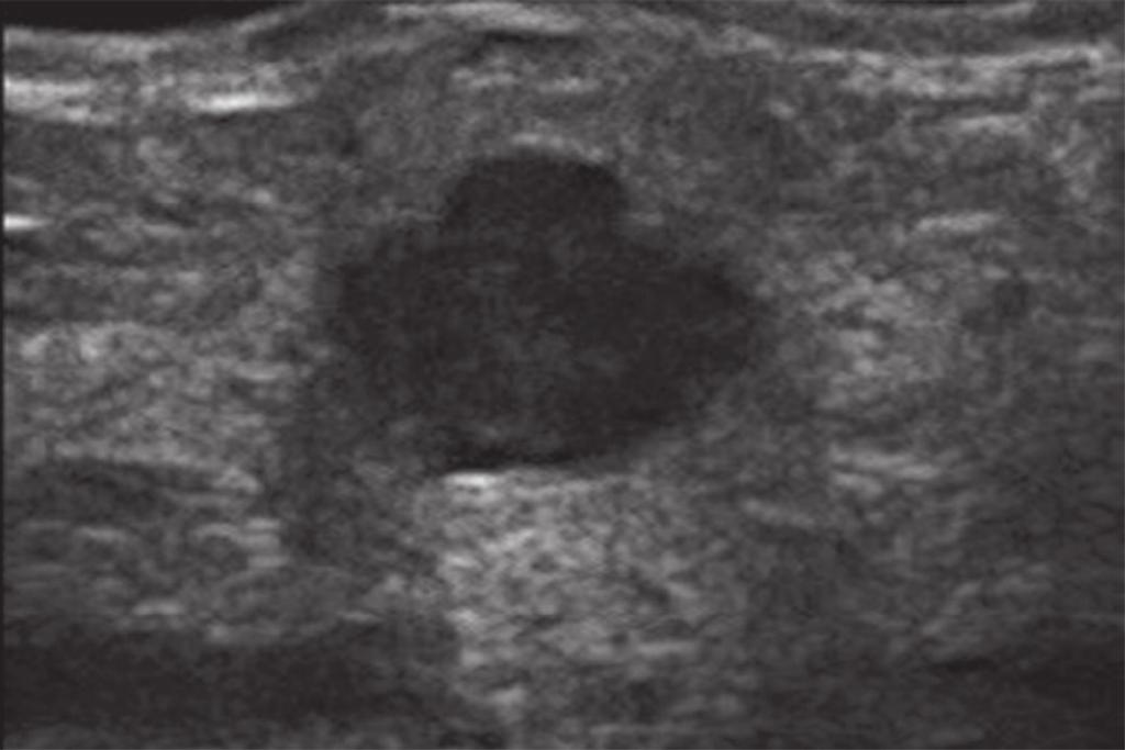 Incidências mamográficas em mediolateral oblíqua mostrando diversas calcificações distróficas predominando nos quadrantes superiores das mamas. Paciente com diagnóstico clínico de esclerodermia.