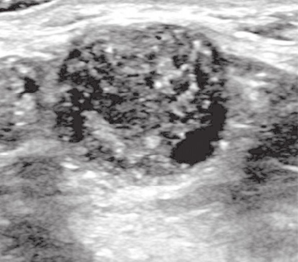 Matsumoto REK et al. / spectos de imagem da mama em doenças sistêmicas Figura 13.