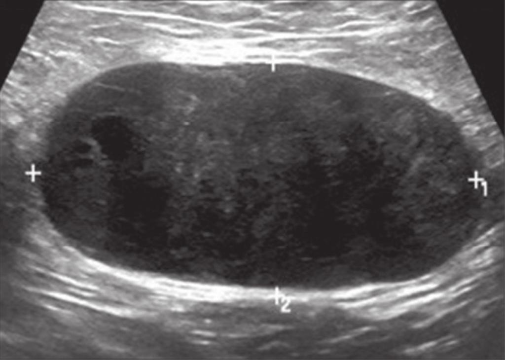 Realizada biópsia percutânea desse nódulo, que confirmou o acometimento secundário da mama pelo melanoma. apresentar calcificações em carcinomas de ovário (Figura 14) ou de tireoide.