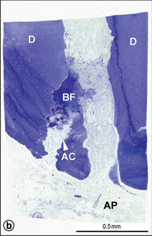 44 Figura 9 Presença de biofilme bacteriano em canal acessório Fonte: NAIR, 2006, p.