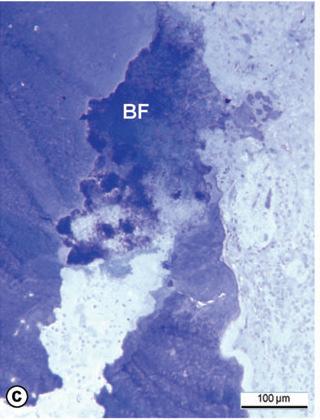 organizadas em biofilmes aderidas às paredes dentinárias ou em áreas de difícil acesso são extremamente