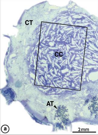 67 Figura 16 (a) Corte histológico, evidenciando a presença de cristais de colesterol em lesão periapical; (b) reação de corpo estranho com a presença de células gigantes ao redor dos cristais Fonte: