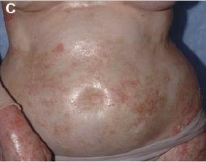 sclerosis and may lead to restricted chest wall expansion (C).