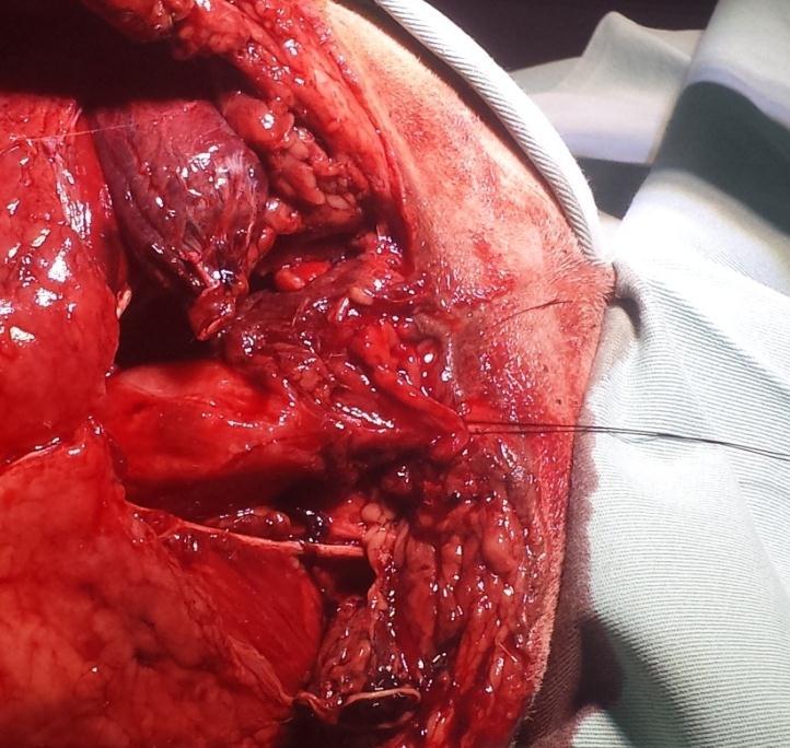 Neste procedimento de caudectomia, foi possível observar a perda de toda estrutura anal e da região caudal do reto, acometendo os músculos elevadores do ânus, músculos coccígeos e dilaceração do