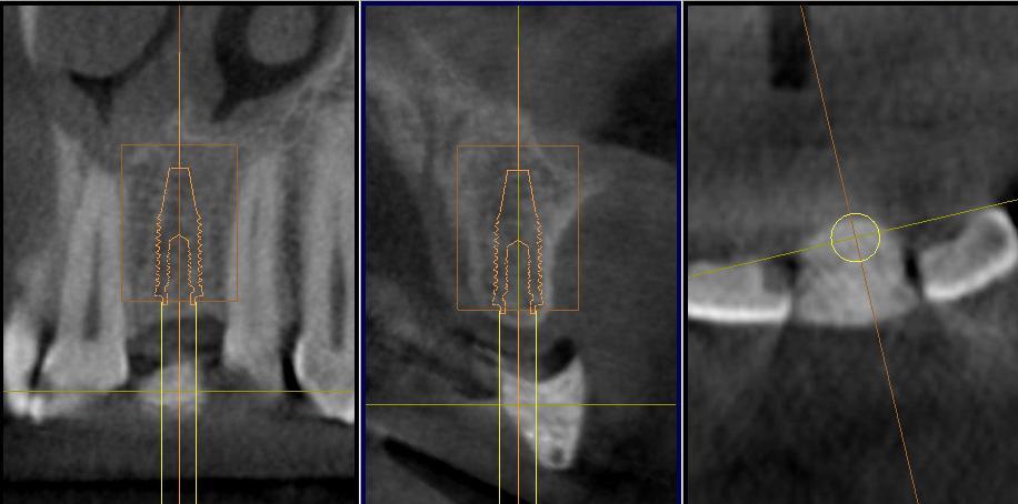 1 2 3 Figura 9b Vistas bidimensionais da tomografia computorizada de feixe cónico efectuada pelo aparelho Galileos 3D da Sirona