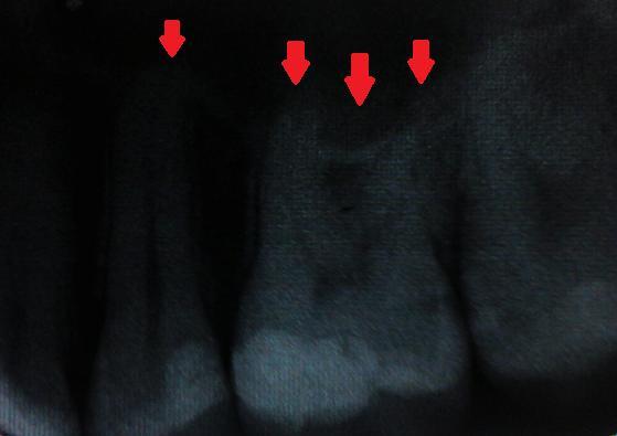 Figura 2 Imagem de uma radiografia periapical na qual a relação entre as raízes dos dentes 25 e 26 e o seio maxilar é de difícil compreensão.
