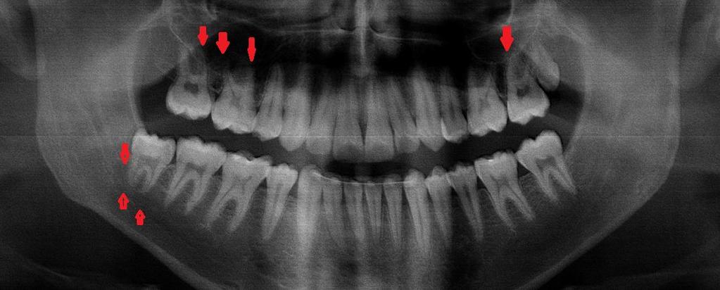 Figura 5 Imagem de uma radiografia panorâmica na qual a relação entre as raízes dentárias