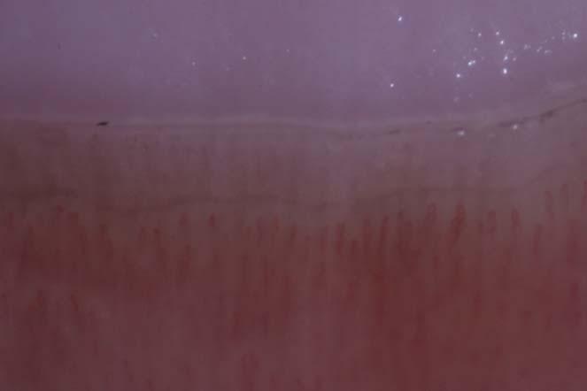 Figura 7: Capilaroscopia de indivíduo normal. Visualizam-se alças capilares regulares em tamanho e forma, distribuídas uniformemente no leito ungueal. Presença de vaso tortuoso (seta). 2.