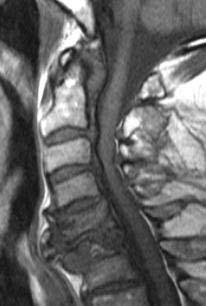 o envolvimento circunferencial da artéria vertebral (seta